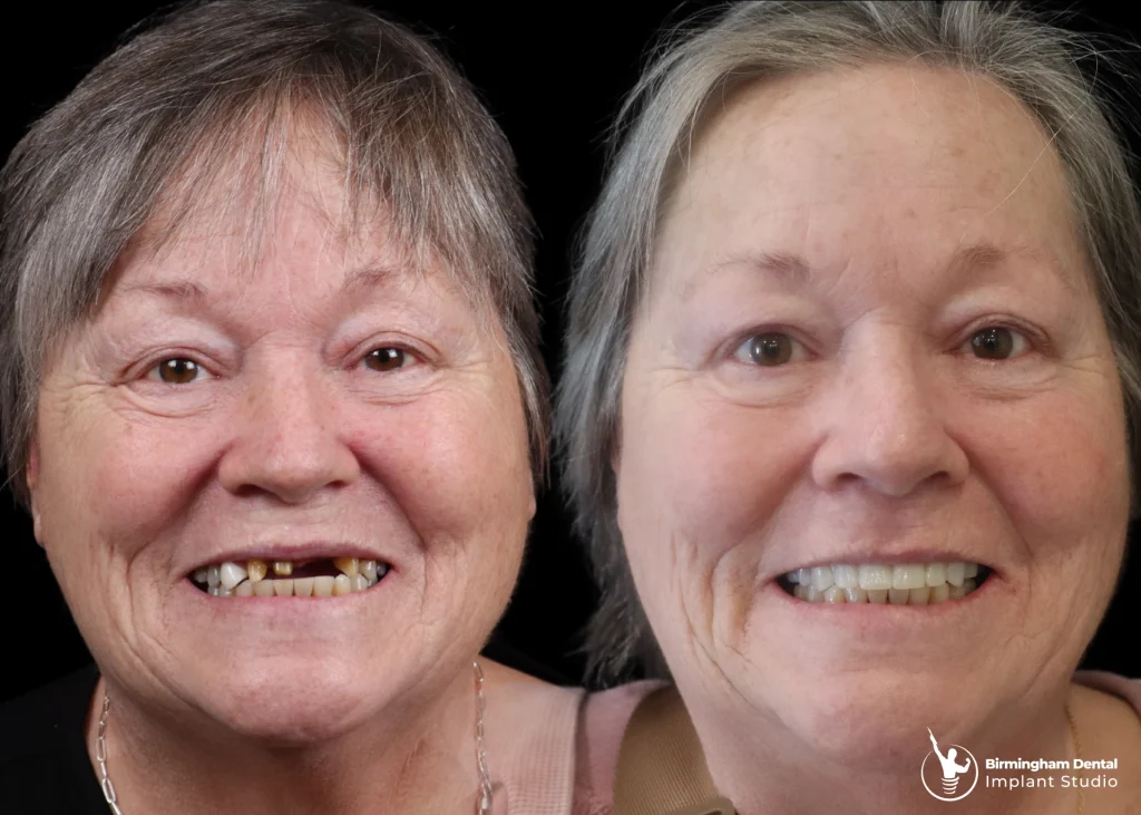 Before and after dental implants in Birmingham at Birmingham Dental Implant Studio