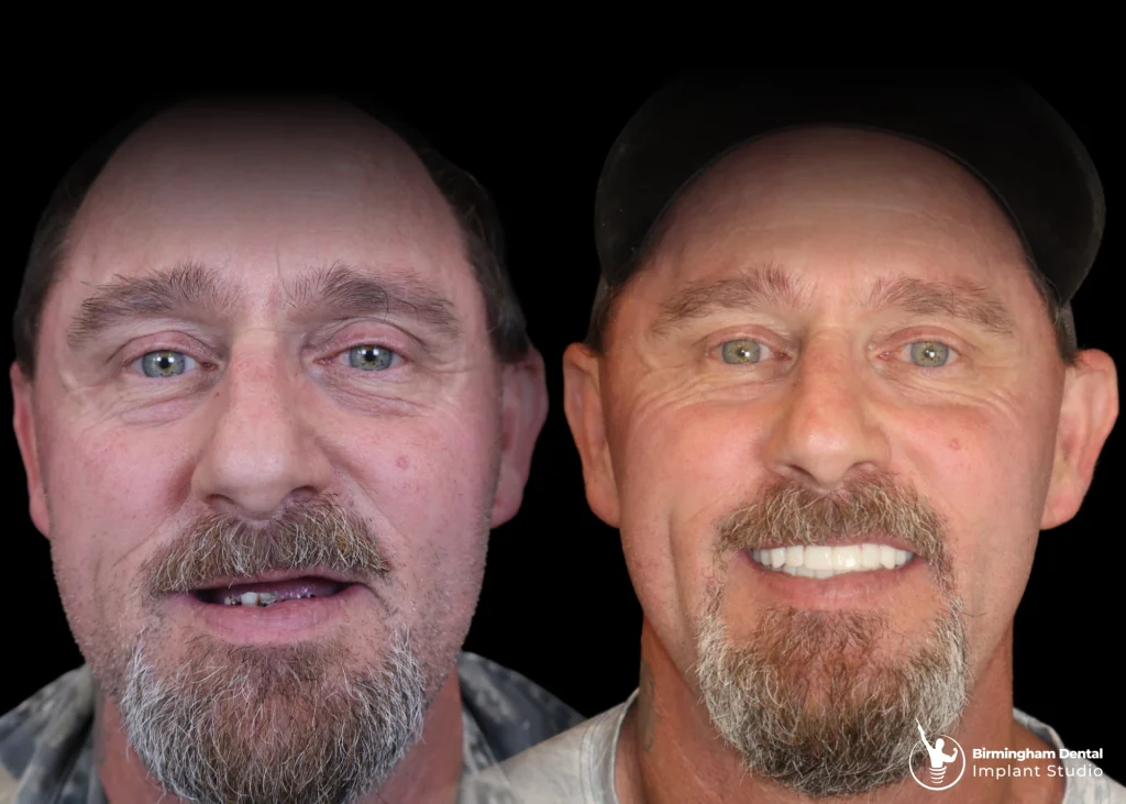 Before and after dental implants in Birmingham at Birmingham Dental Implant Studio