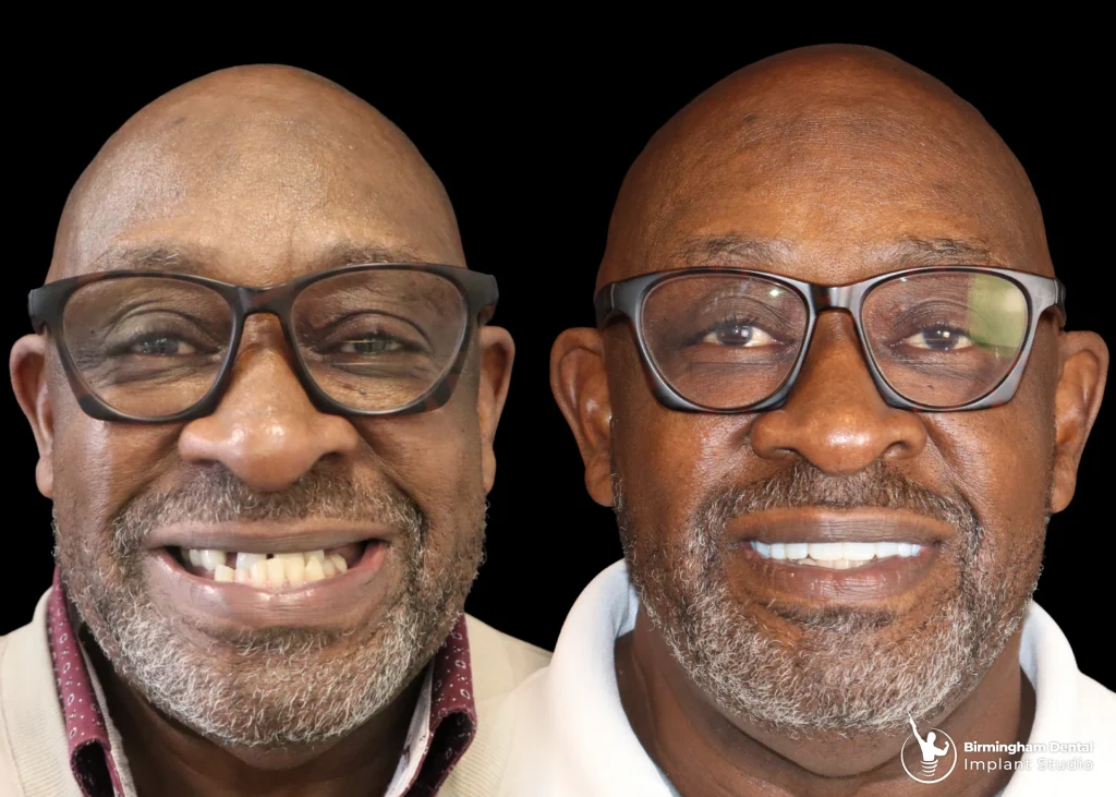 Before and after dental implants in Birmingham at Birmingham Dental Implant Studio