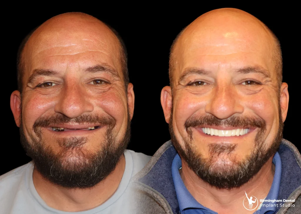 Before and after dental implants in Birmingham at Birmingham Dental Implant Studio