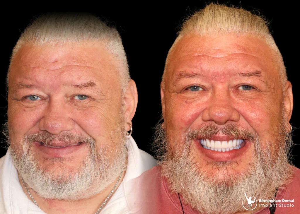 Before and after dental implants in Birmingham at Birmingham Dental Implant Studio