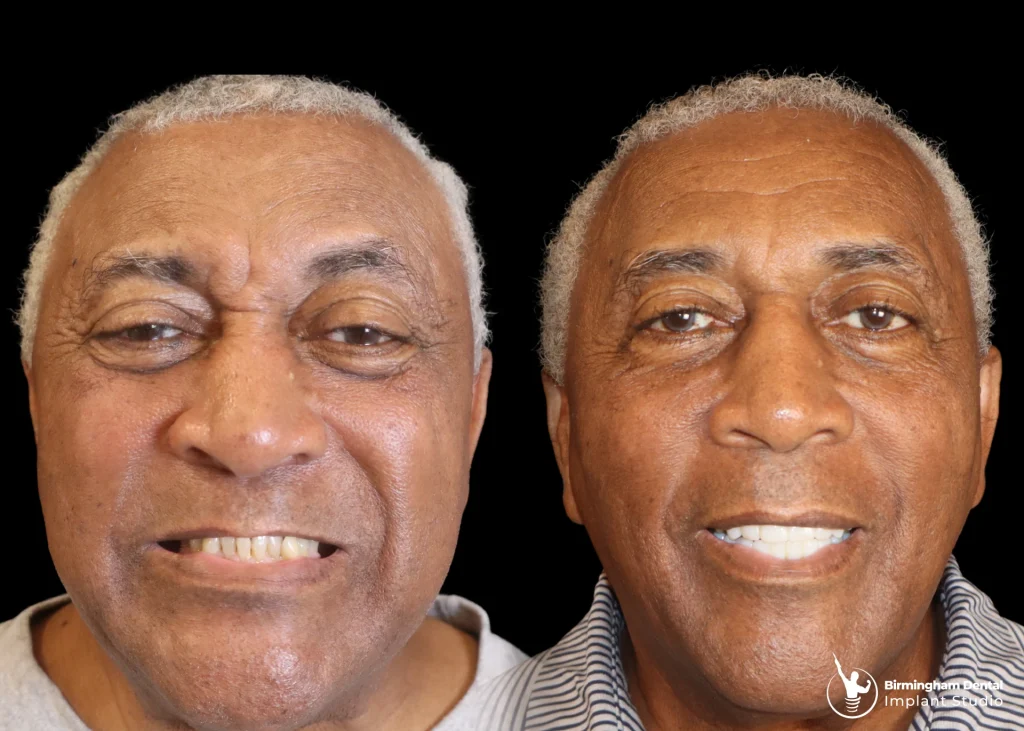 Before and after dental implants in Birmingham at Birmingham Dental Implant Studio