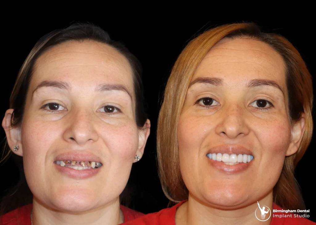 Before and after dental implants in Birmingham at Birmingham Dental Implant Studio