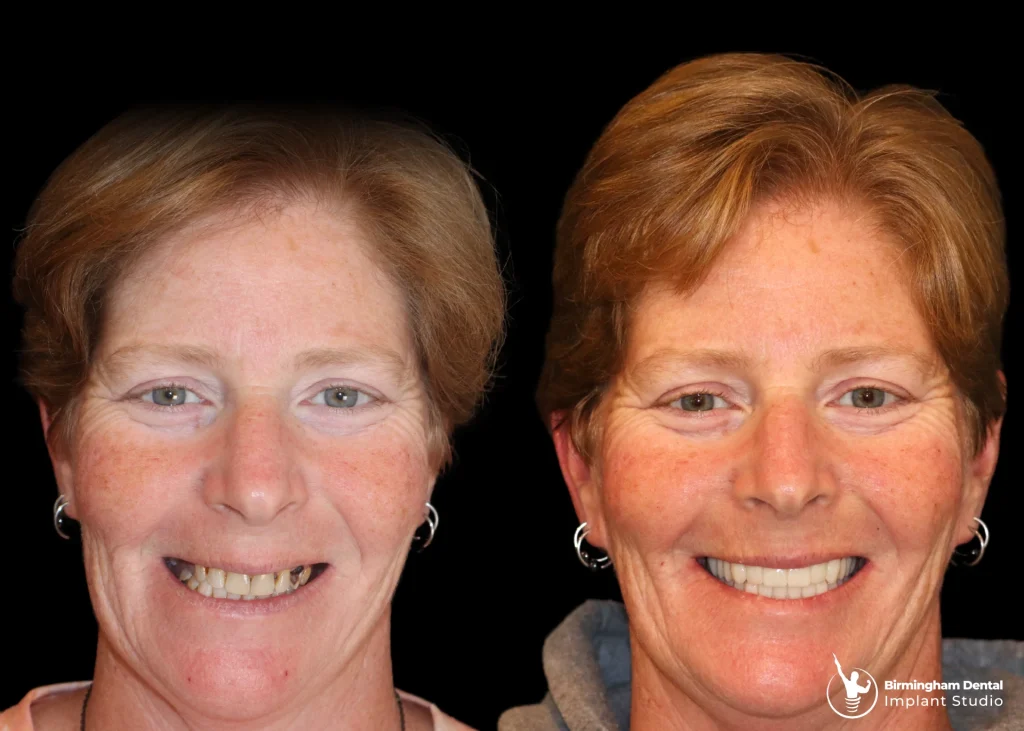 Before and after dental implants in Birmingham at Birmingham Dental Implant Studio