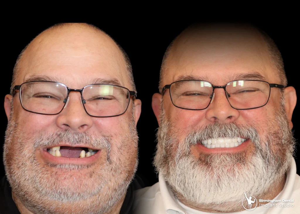 Before and after dental implants in Birmingham at Birmingham Dental Implant Studio