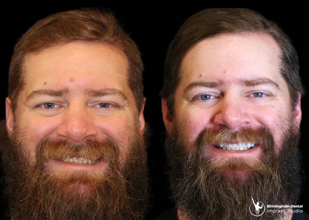 Before and after dental implants in Birmingham at Birmingham Dental Implant Studio