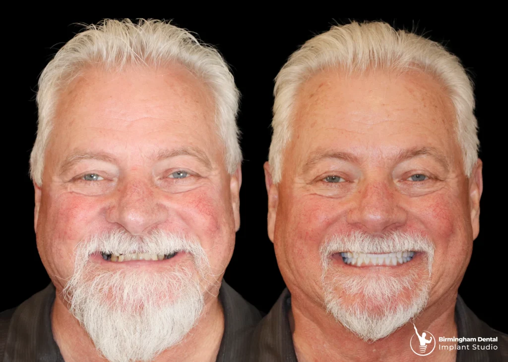 Before and after dental implants in Birmingham at Birmingham Dental Implant Studio