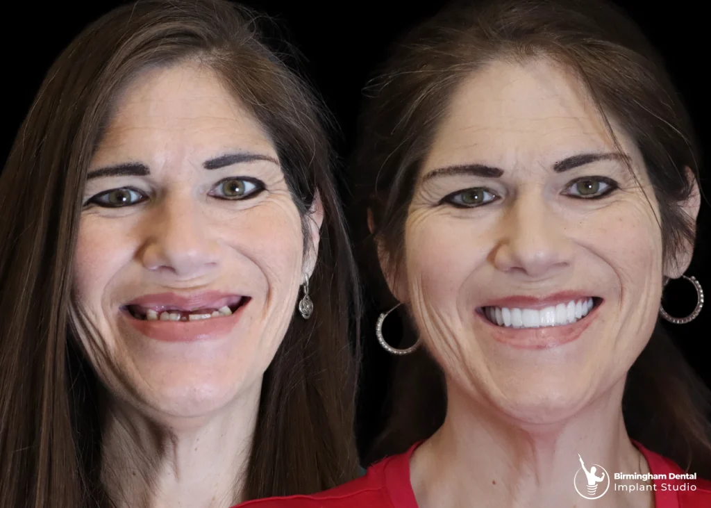Before and after dental implants in Birmingham at Birmingham Dental Implant Studio