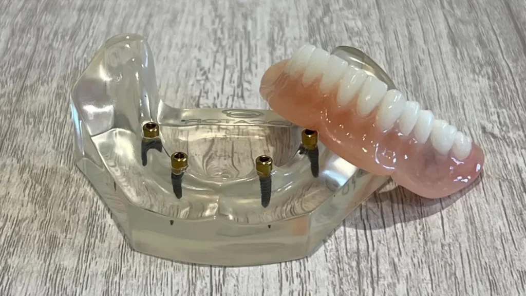 Snap-In Implant Dentures in Birmingham, AL – Option for full-arch teeth replacement.